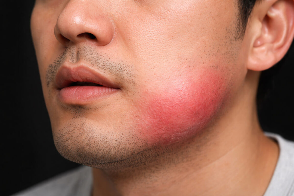 Как опухоль челюсти привела к выявлению редкого синдрома SAPHO